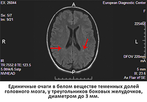 очаги головного мозга