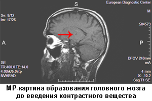 мрт головного мозга с контрастом