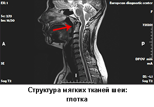 анатомия мрт шеи, щитовидная железа, глотка