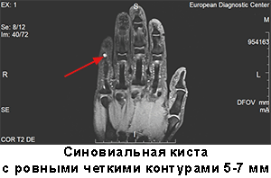 мрт суставов кисти, мрт руки цена, гигрома, киста