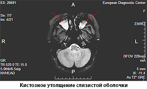 Кистозное утолщение слизистой оболочки, МРТ мозга